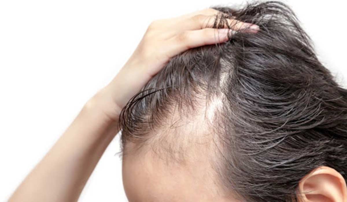 Tratamientos de pérdida de cabello en Panamá