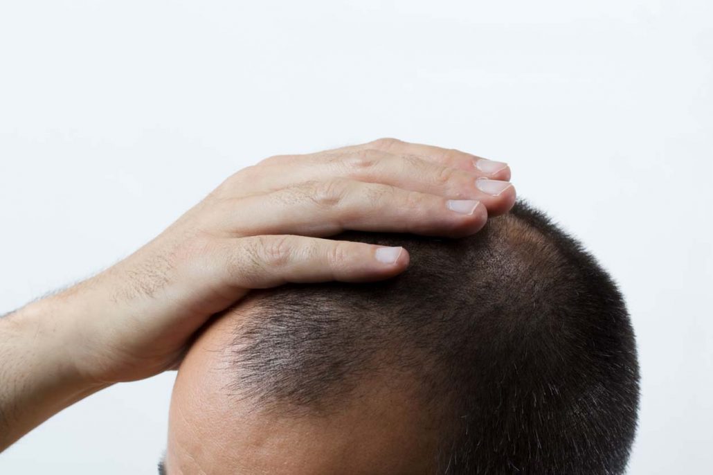 Trasplante de Cabello Barato