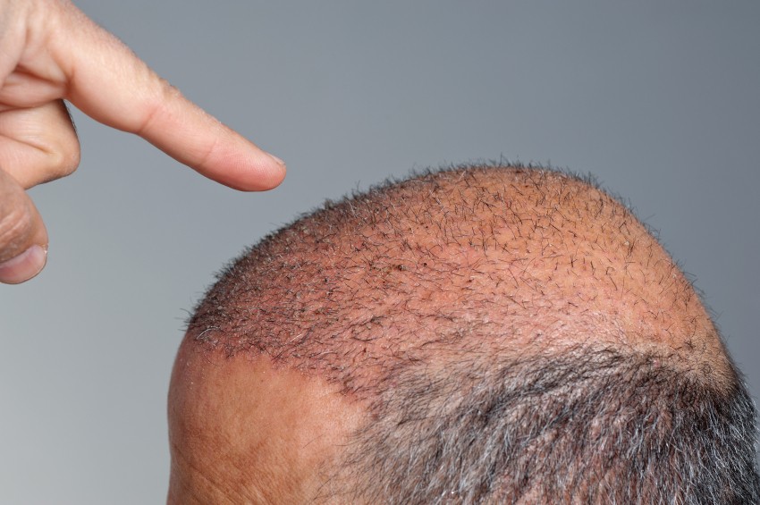 consejos trasplante cabello