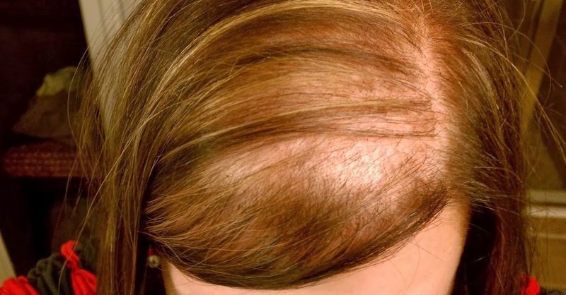 remedio para calvicie en mujeres
