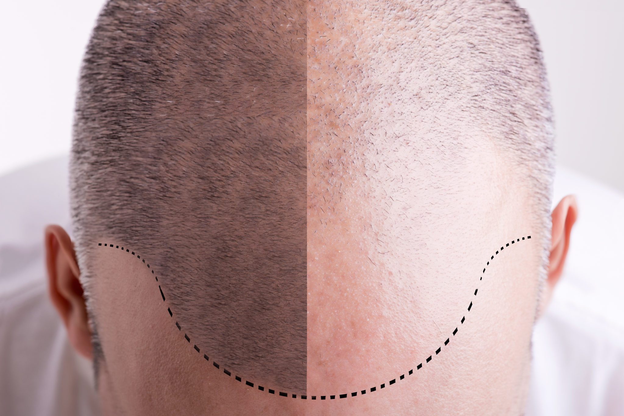 trasplante