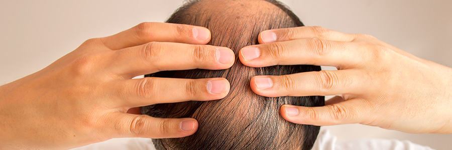 Restauración de Cabello en Latino américa