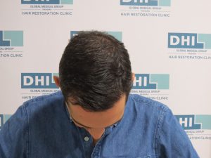 Resultado de Transplante de Cabello - Norwood 4