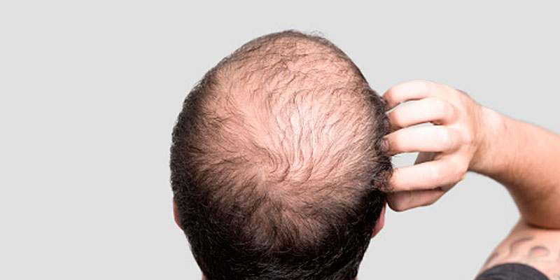 alopecia androgenética