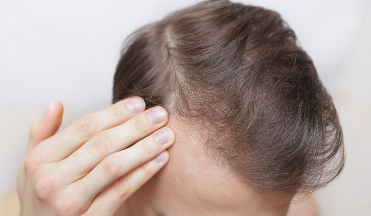 picazón después del trasplante de cabello