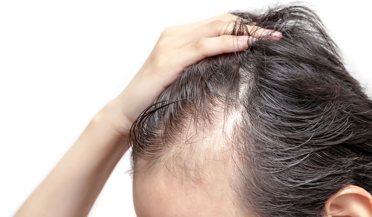la línea del cabello