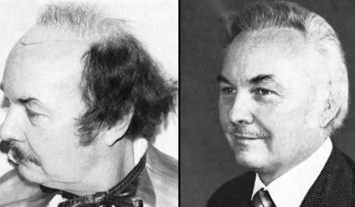 HISTORIA DEL TRASPLANTE DE CABELLO