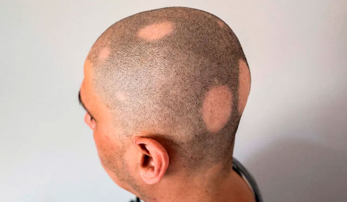 la alopecia Areata
