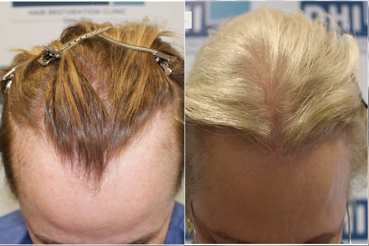 El Trasplante de Cabello DHI Ayuda a Mujeres con Alopecia