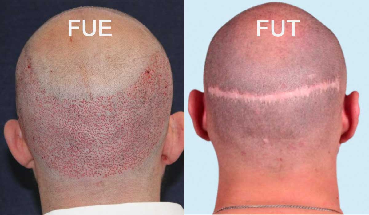 FUE vs FUT en el Trasplante de Cabello