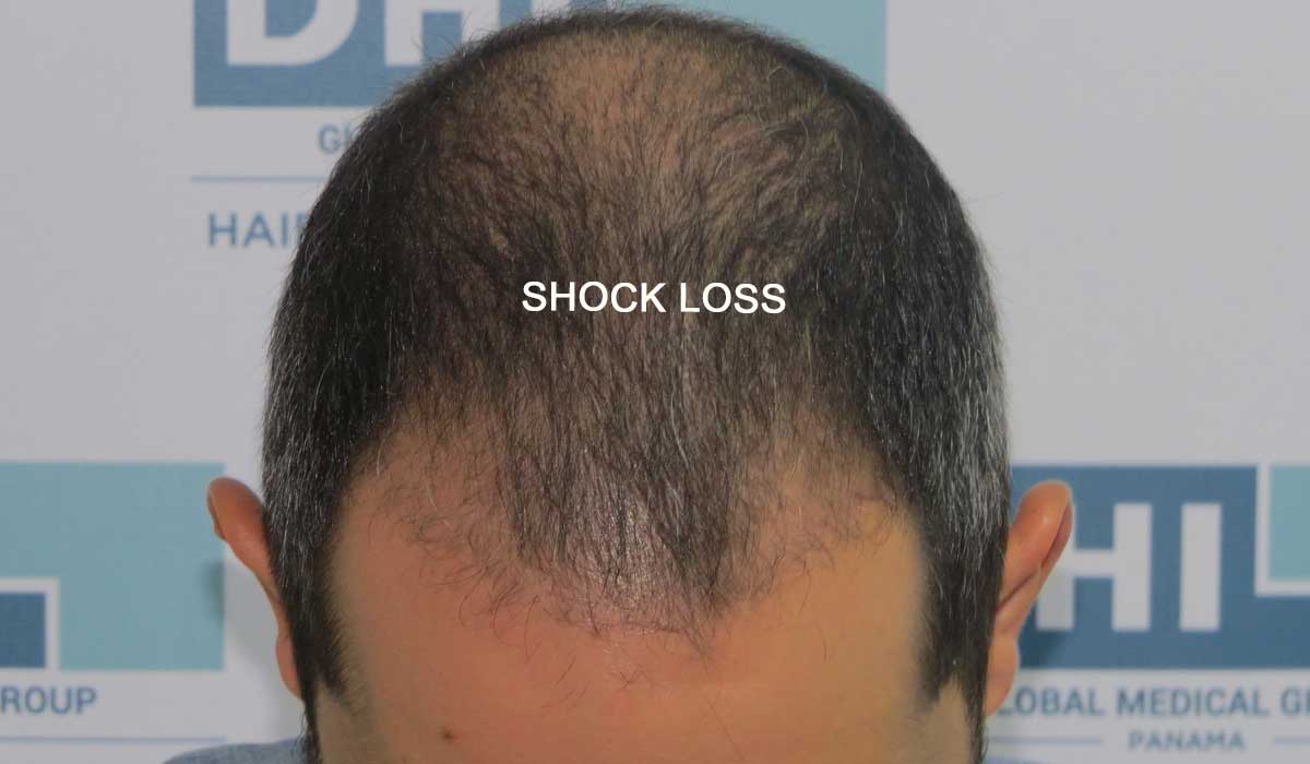 La Fase de Choque en el trasplante de cabello DHI