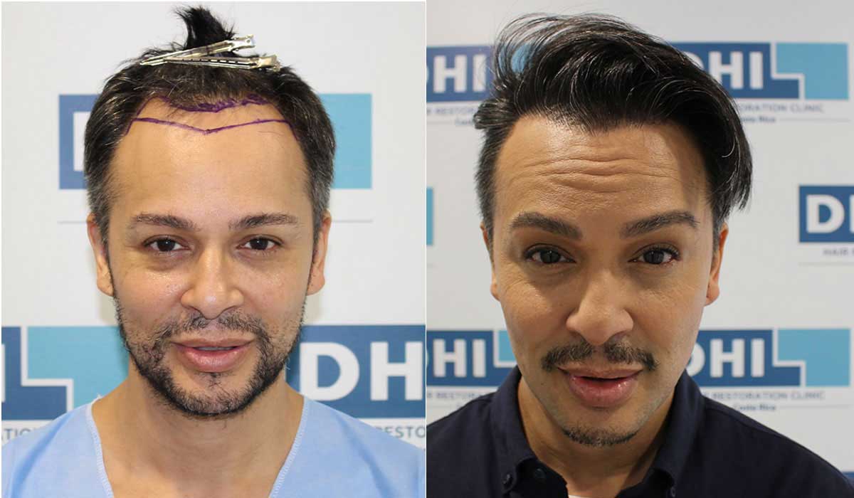 el Verdadero Trasplante de Cabello DHI