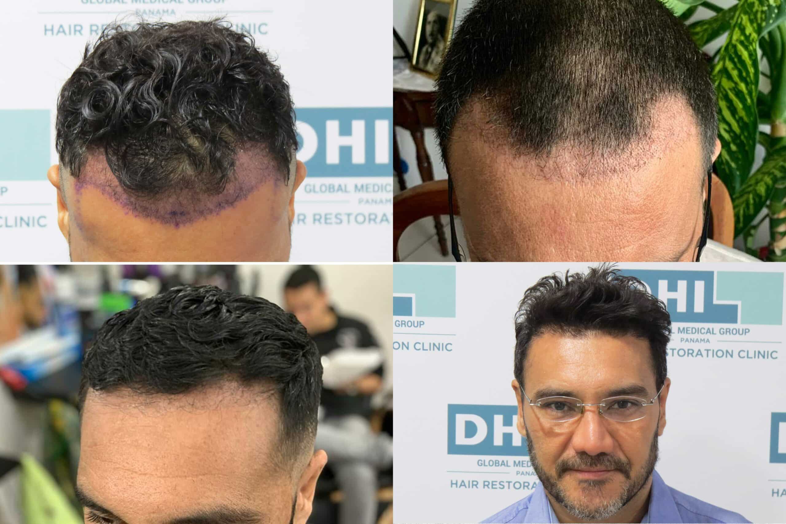 Mes a Mes Después de un Trasplante de Cabello