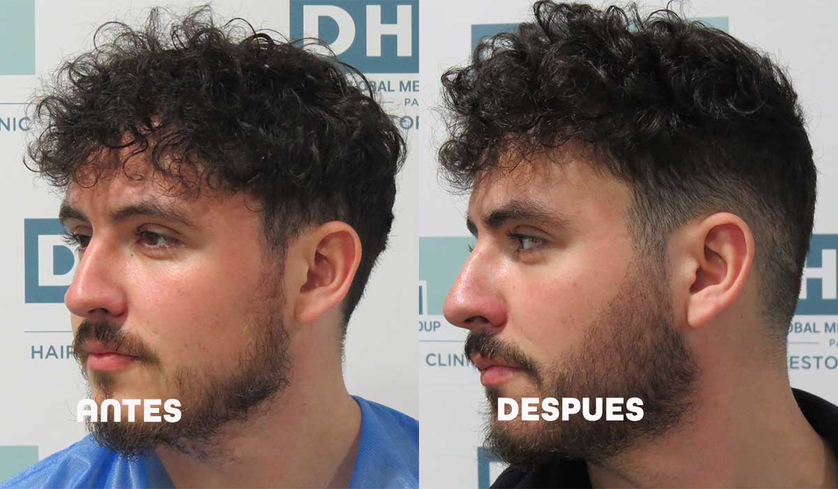Cambiando el mundo en el Trasplante de Barba