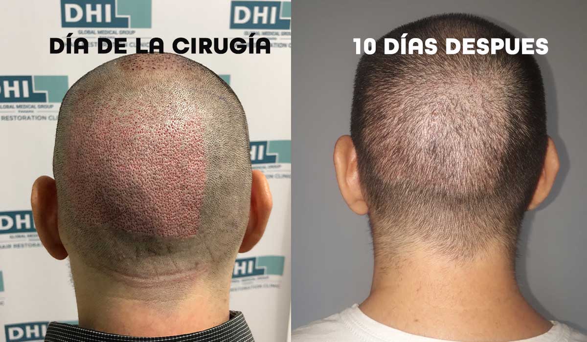 Recuperación de Zona donante