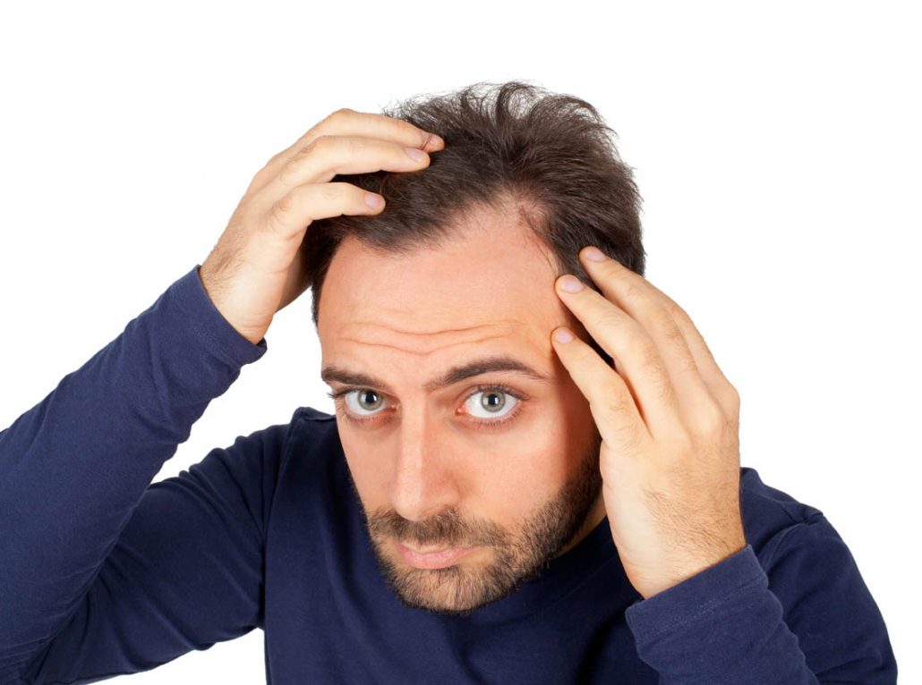 Types of hair loss in Panama - DHI Panamá