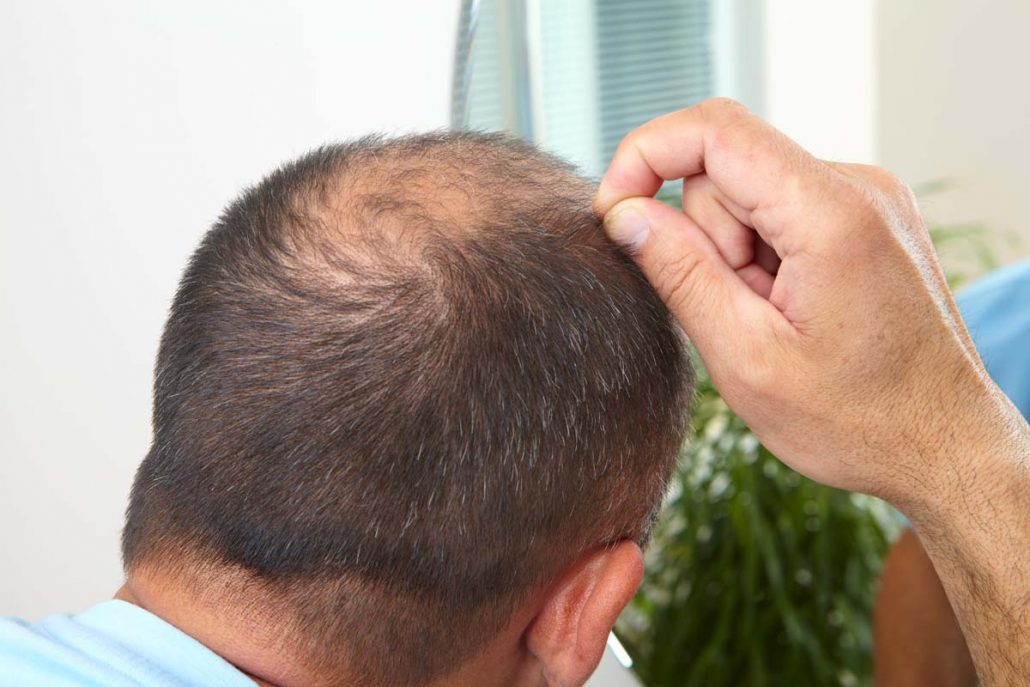 Treatment for hair loss Panama with the the expert DHI GROUP