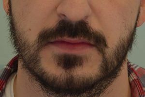 1073-after-front trasplante de barba
