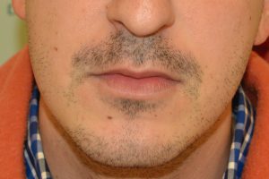 1073-before-front trasplante de barba