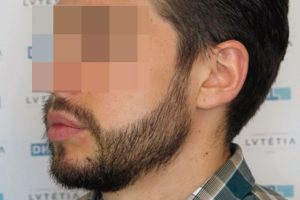 5741-side-after trasplante de barba