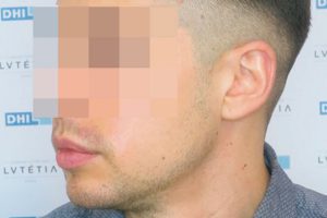 5741-side-before trasplante de barba