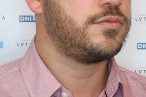 Barba-side-after2-0085