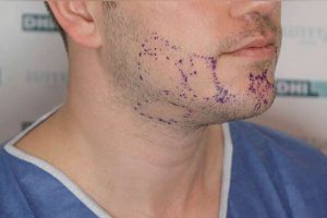 Barba-side-before2-0085