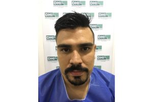 trasplante de barba