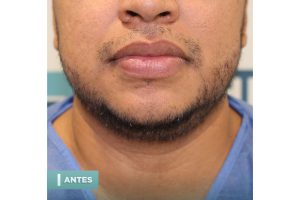 trasplante de barba