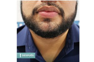 trasplante de barba