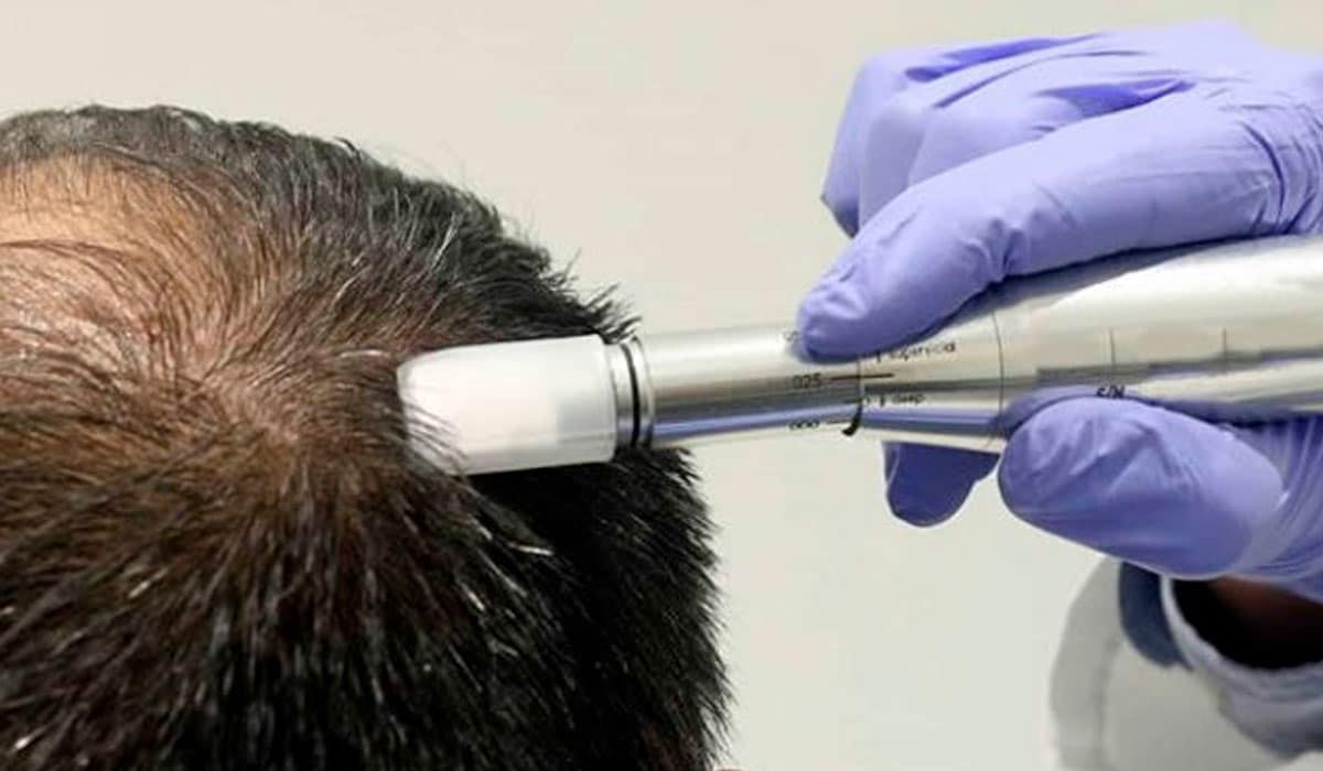 LA MESOTERAPIA CAPILAR