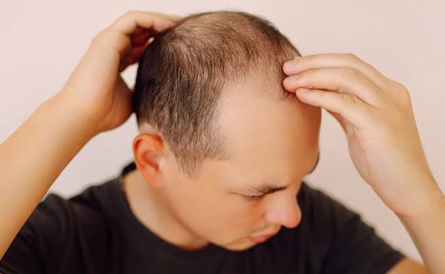Tipos de Alopecia Perdida de Cabello DHI Panamá