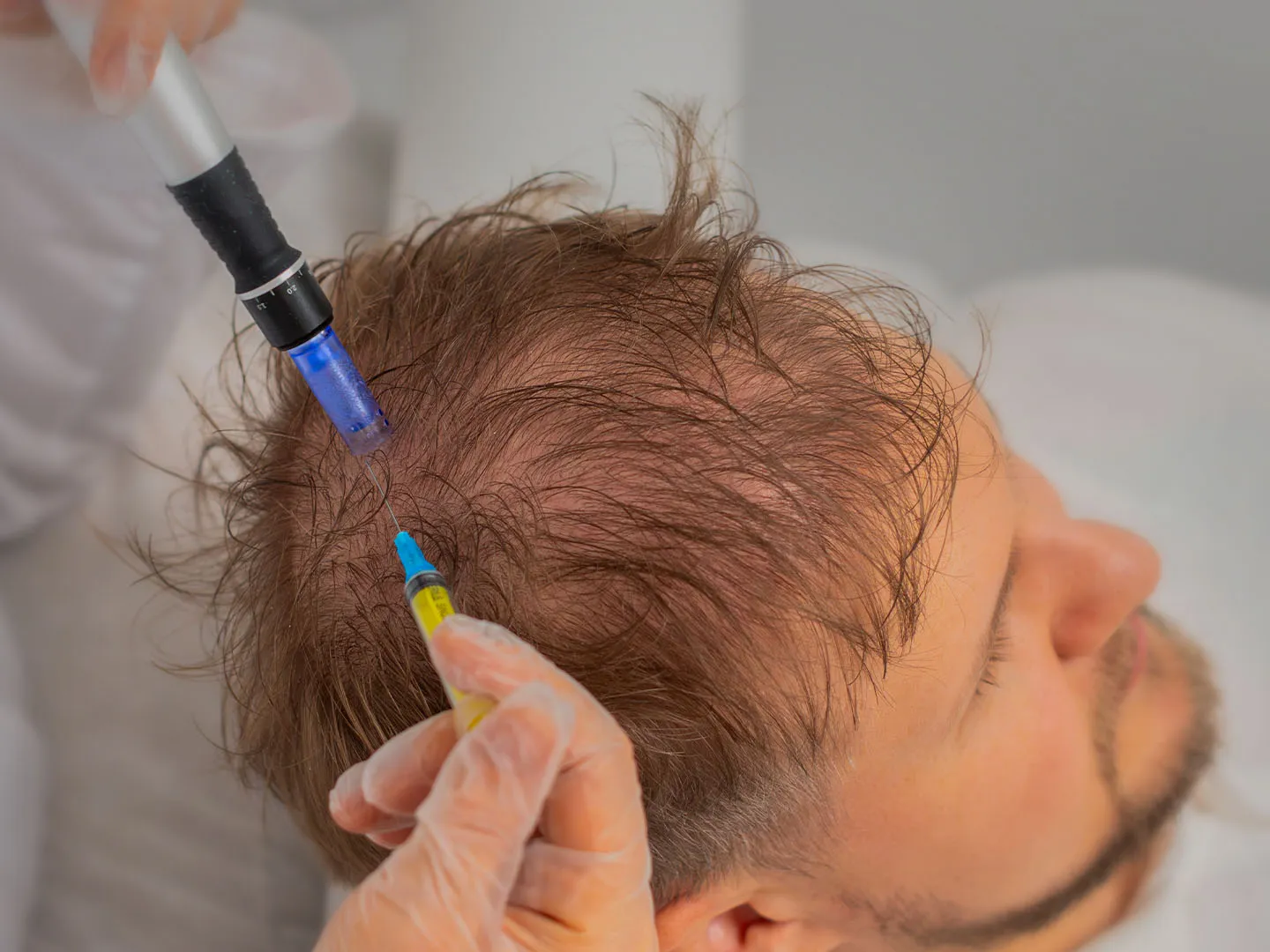 Tratamientos capilares sin cirugía: PRP, mesoterapia y exosomas